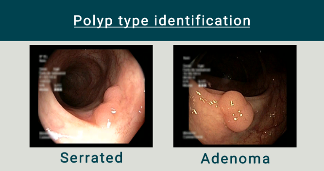 Desktop polyp training identification, v2.0