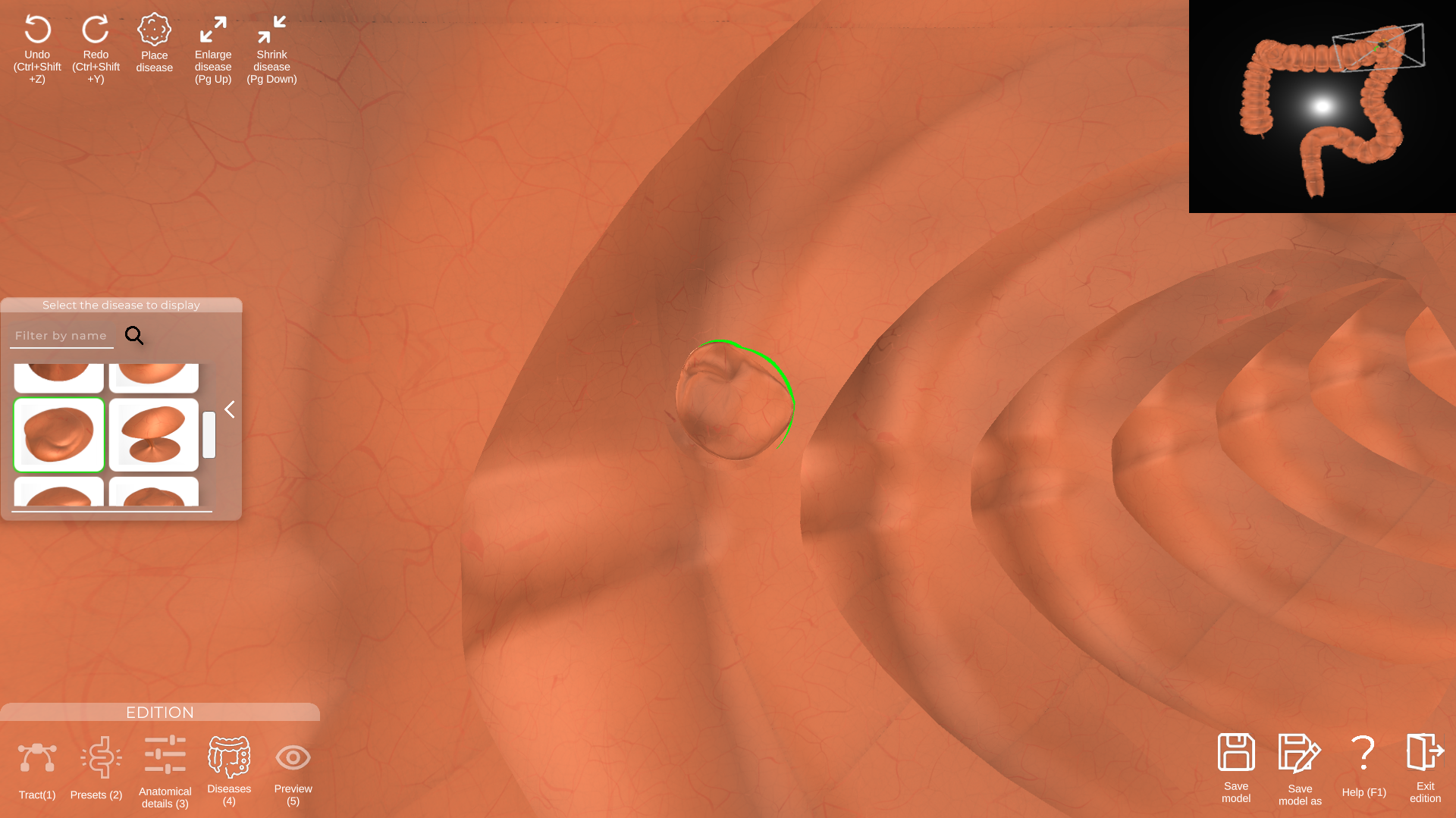 Polyp pathology placement in the desktop model editor, v1.0